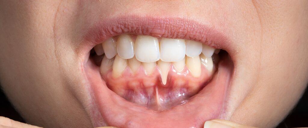 Gum Recession