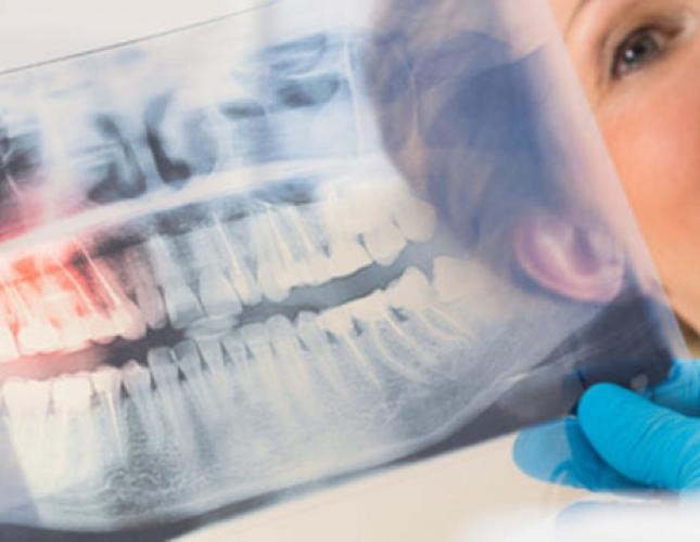 Yes, Teeth Cleanings Really Do Matter