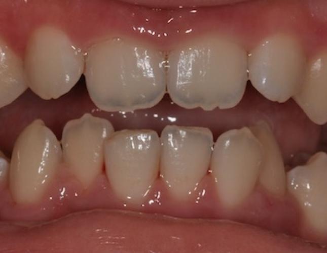 Braces before