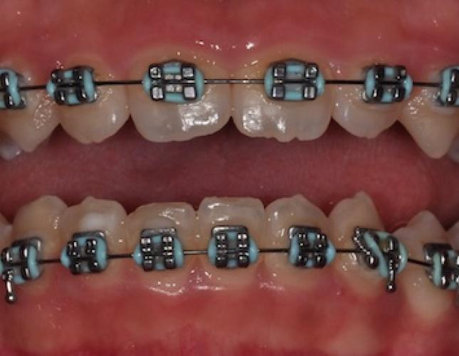 Braces after