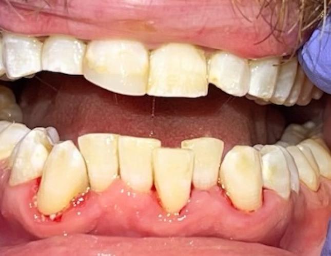 Teeth cleaning after