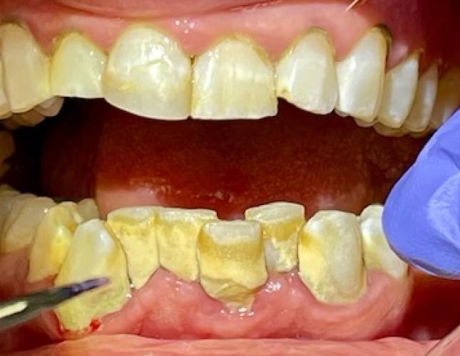 Teeth cleaning before
