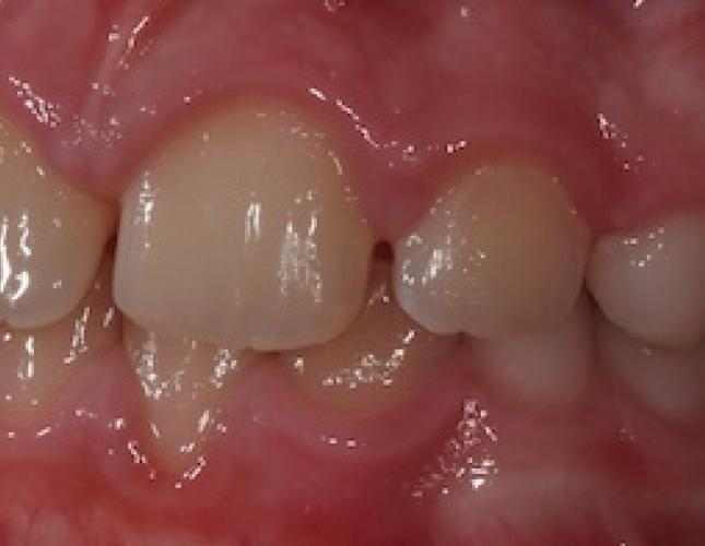 Braces after