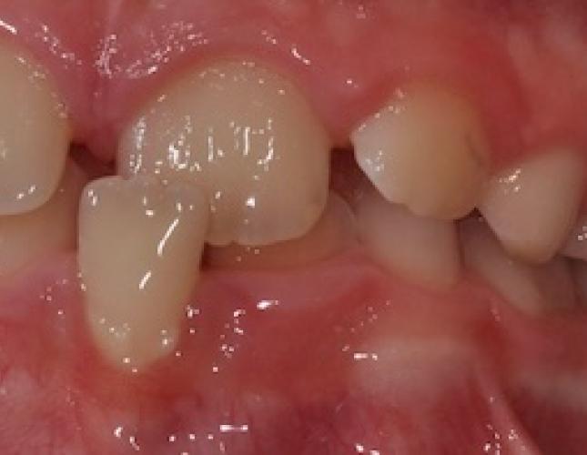 Braces before