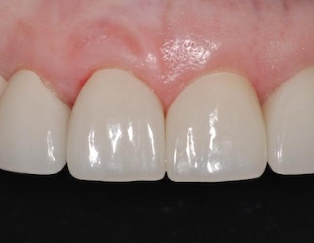 Crowns after