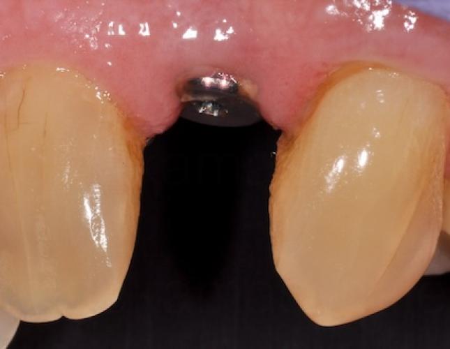 Dental implant after