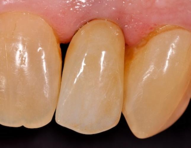 Dental implant before