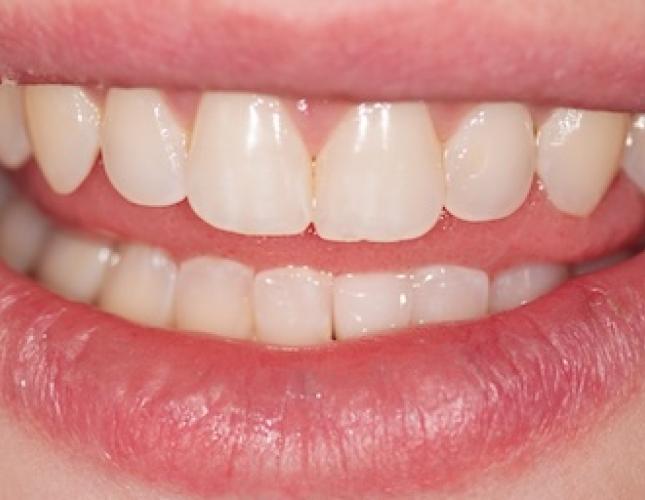 Missing tooth after