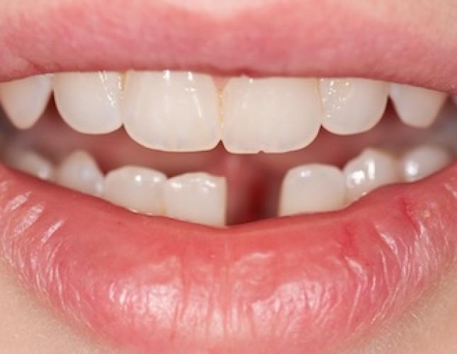 Missing tooth before