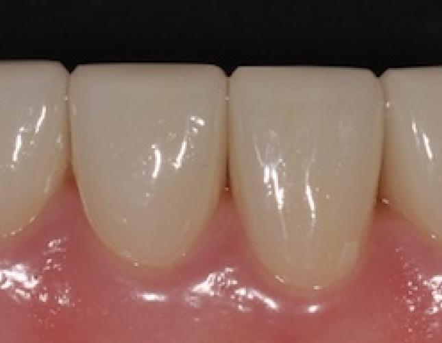 Veneers after