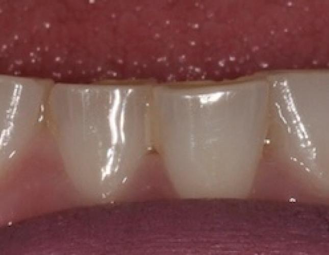 Veneers before