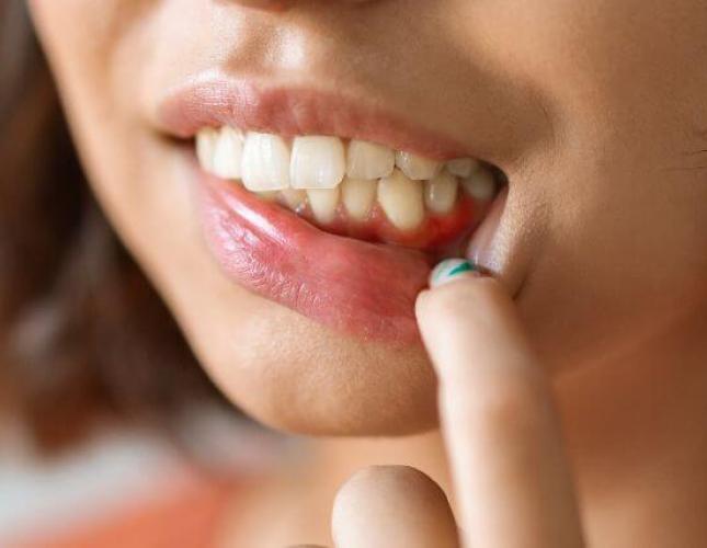 Causes of Gingivitis: Uncovering the Culprits Behind Gum Inflammation