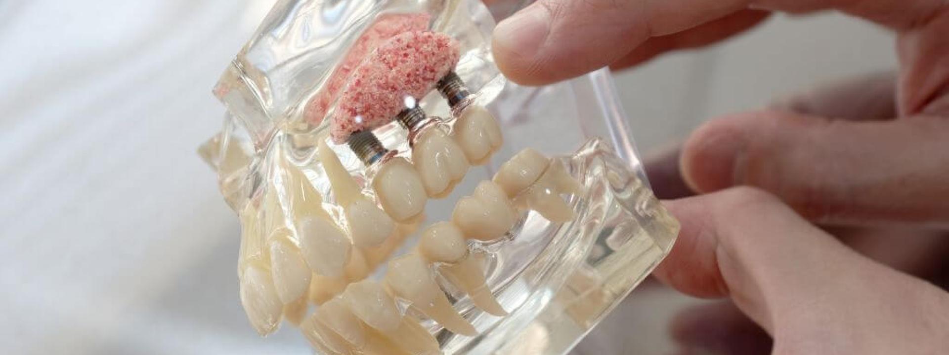 Sinus Lift Surgery: Making Dental Implants Possible
