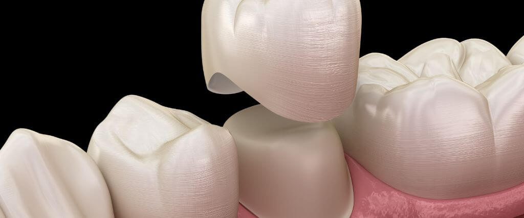Right Material for Your Smile